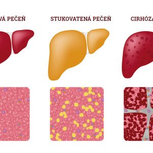 Stukovatená pečeň, steatóza – týka sa aj Vás?