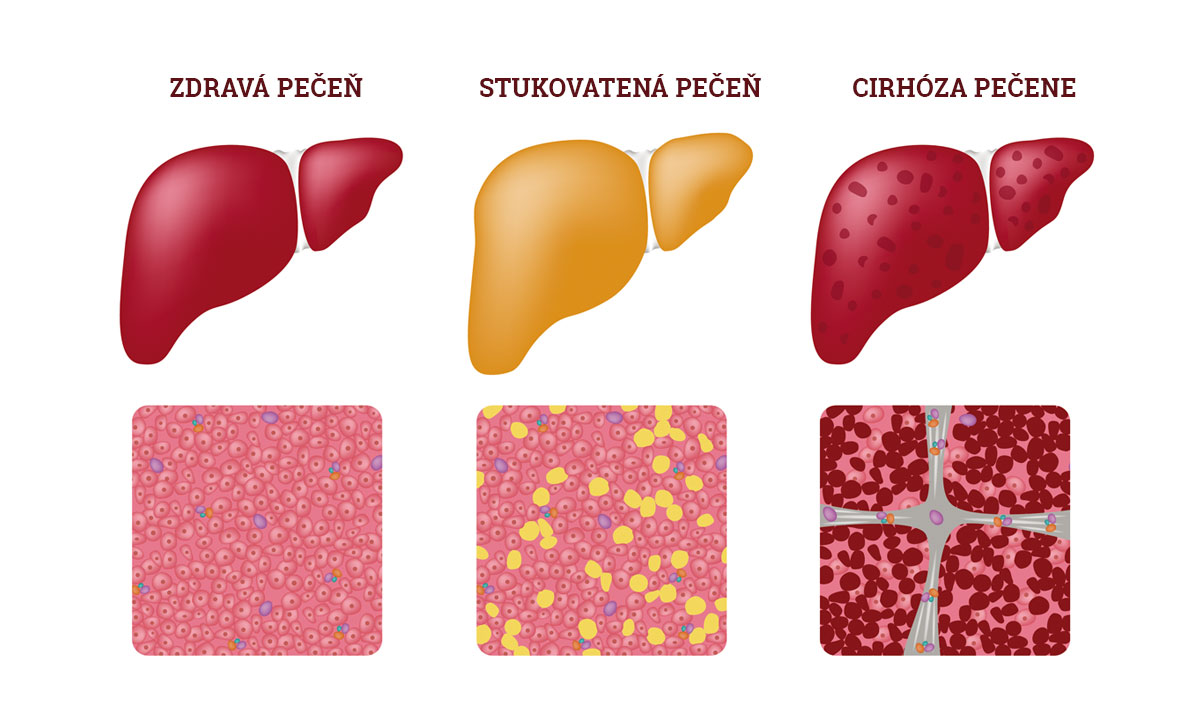 Stukovatená pečeň, steatóza – týka sa aj Vás?